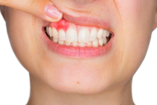 gum disease - Beachside Smiles helps you to prevent and helps with early prevention of gum disease