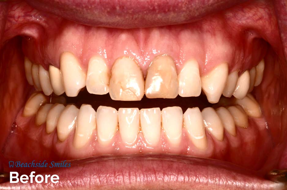Dentist In Manhattan Beach - Before and After Smile