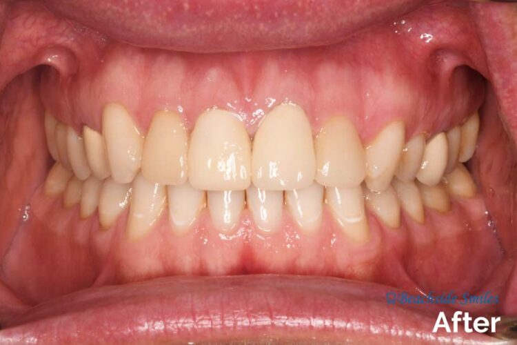 Smile Gallery - Beachside Charle's case after smile makeover