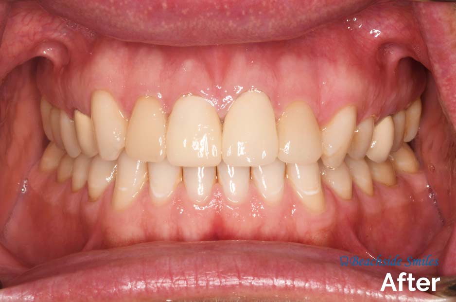 Dentist In Manhattan Beach - Before and After Smile