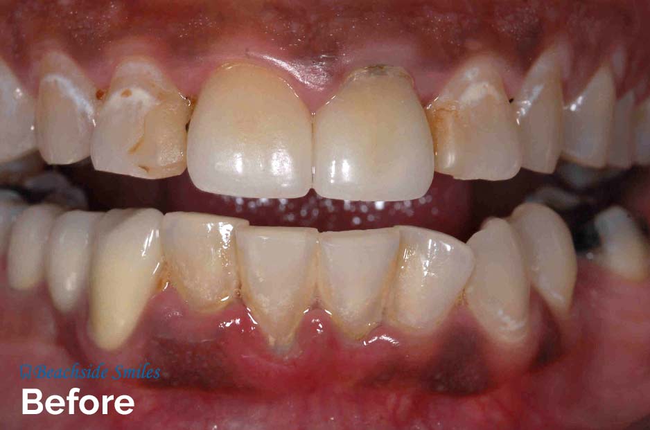 Dentist In Manhattan Beach - Before and After Smile