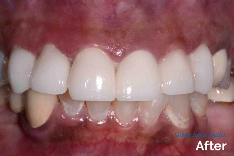 Smile Gallery - Beachside Talia 's case after smile makeover
