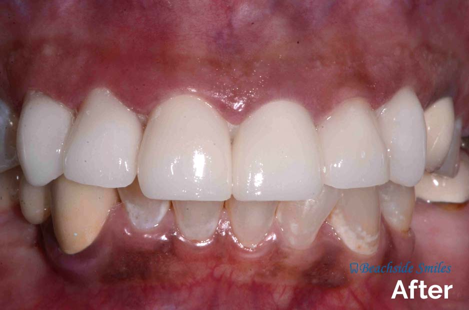 Dentist In Manhattan Beach - Before and After Smile