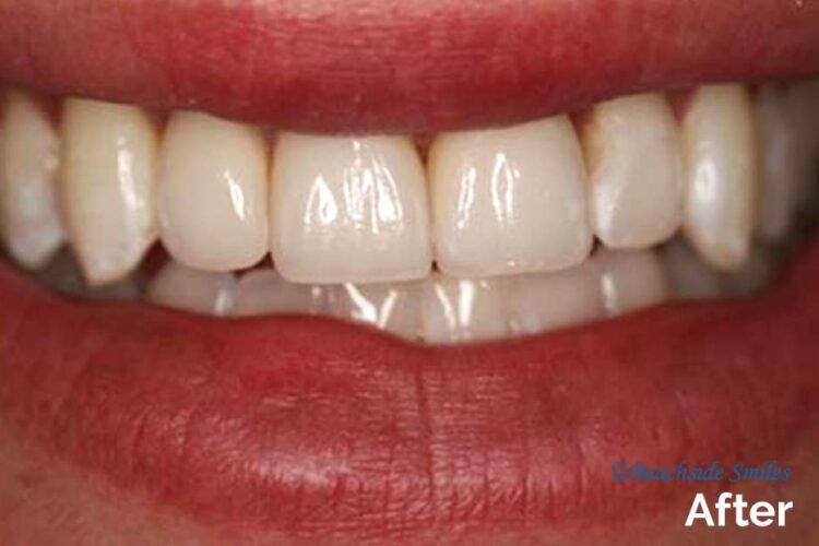 Smile Gallery - Beachside Crace's case after smile makeover