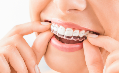 Invisalign - a great way to straighten your teeth with a subtly quickly and comfortably way to get a great smile