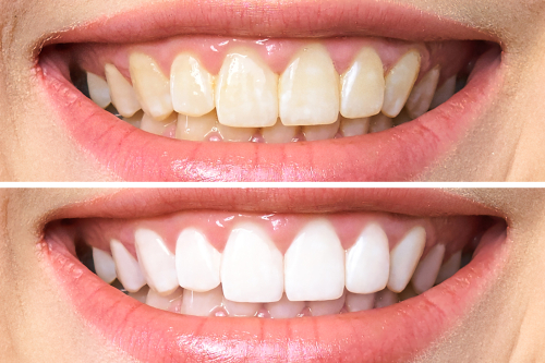 teeth whitening - for a whiter and brighter smile by whitening your teeth