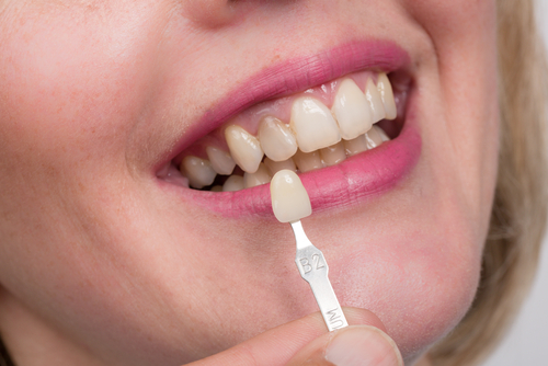 dental crowns - the team at Beachside Smiles helps with selecting which dental crown is best for you
