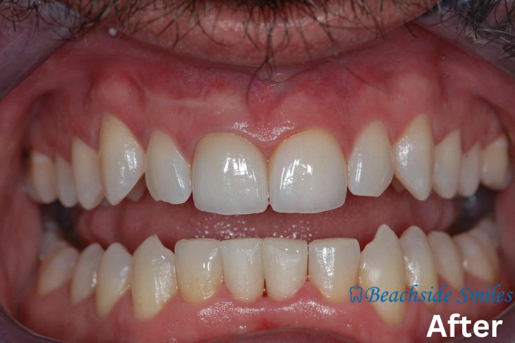 Smile Gallery - Beachside josh's case  after smile makeover