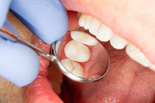 Sports Mouthguards Dental Sealants - helps to maintain the best defense for preventing cavities