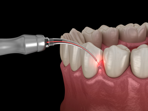 LANAP Gum Disease Treatment - is one of the best forms of dental care to help prevent gum disease