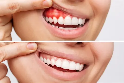 Pinhole Gum Rejuvenation - making your gums healthy again