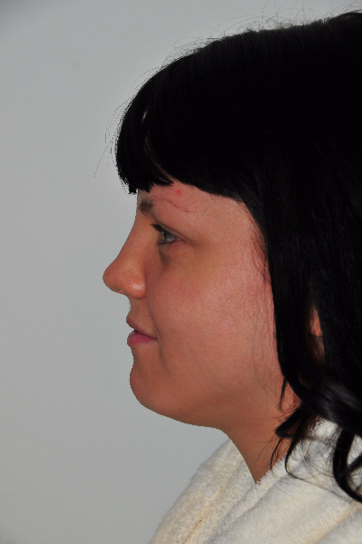 Patient # 66090 After Photo # 2
