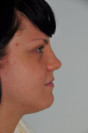 Rhinoplasty Patient