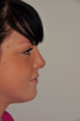 Rhinoplasty Patient