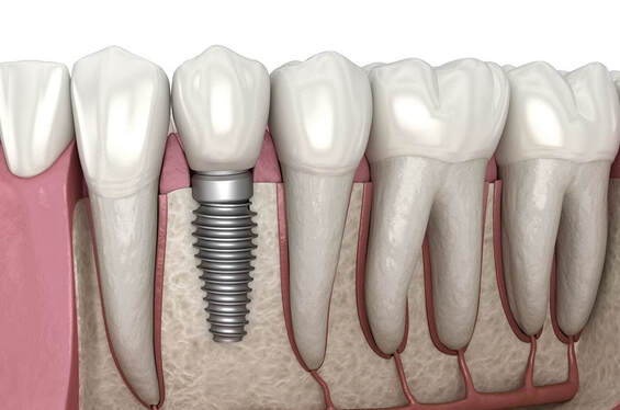 dental implant